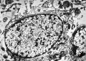 F,12y. | oligodendroglioma